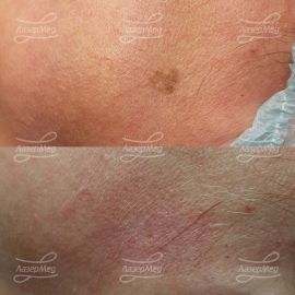 Удаление кератомы