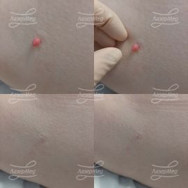 Удаление папилломы