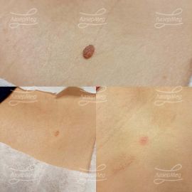 Удаление фибромы мягкой