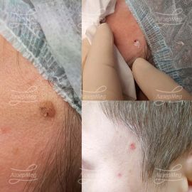 Удаление кератомы