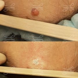 Удаление папилломатозного невуса