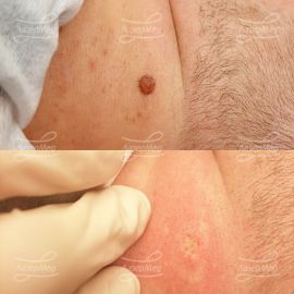 Удаление фибромы