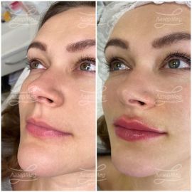 Контурная пластика губ