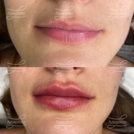 Контурная пластика губ