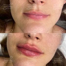 Контурная пластика губ