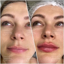 Контурная пластика губ