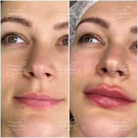 Контурная пластика губ