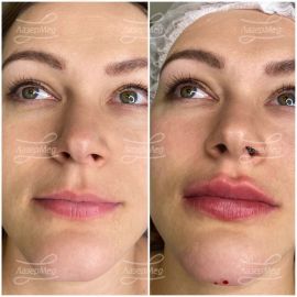 Контурная пластика губ