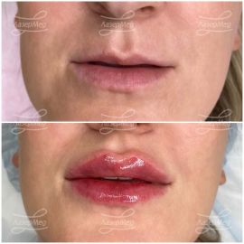 Контурная пластика губ. 2 коррекции с интервалом в 2 месяца (введено 2 мл препарата на основе гиалуроновой кислоты).