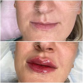 Контурная пластика губ. 2 коррекции с интервалом в 2 месяца (введено 2 мл препарата на основе гиалуроновой кислоты).