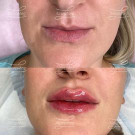 Контурная пластика губ. 2 коррекции с интервалом в 2 месяца (введено 2 мл препарата на основе гиалуроновой кислоты).