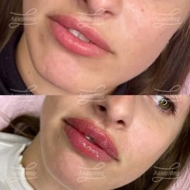 Контурная пластика губ