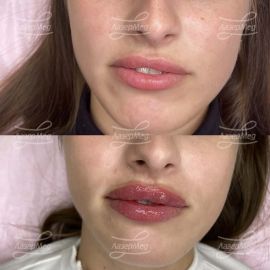Контурная пластика губ