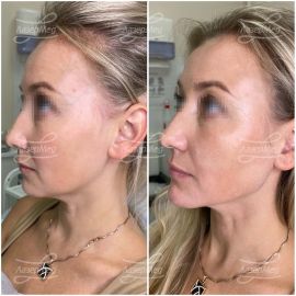 Коррекция овала лица