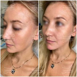 Коррекция овала лица