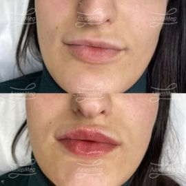 Контурная пластика губ