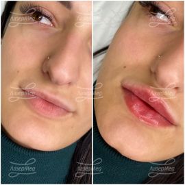 Контурная пластика губ