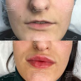 Контурная пластика губ