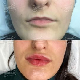 Контурная пластика губ