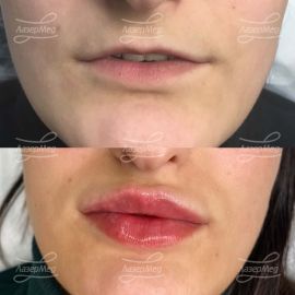 Контурная пластика губ