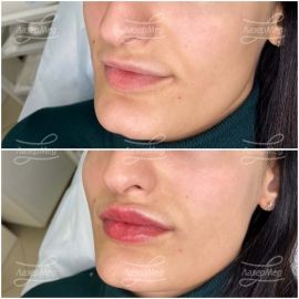 Контурная пластика губ