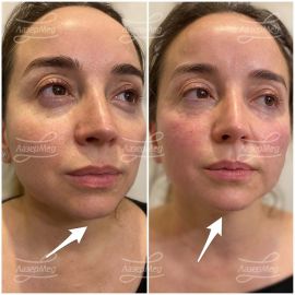 Коррекция подбородка