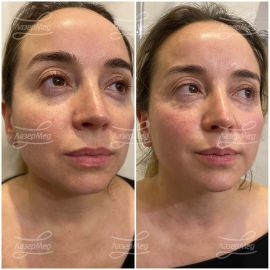 Коррекция подбородка