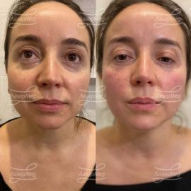 Коррекция подбородка