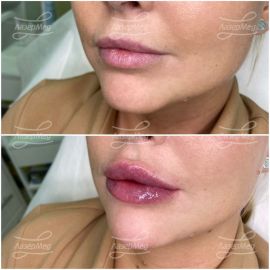 Коррекция подбородка и контурная пластика губ