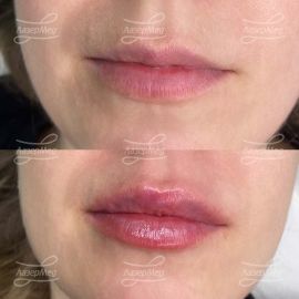 Контурная пластика губ