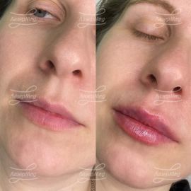 Контурная пластика губ