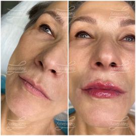 Контурная пластика губ