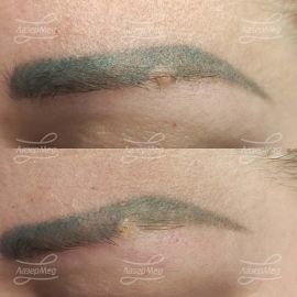 Лазерная деструкция дермального невуса