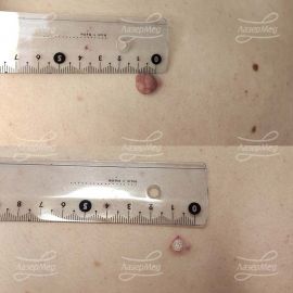 Лазерная деструкция интрадермального невуса