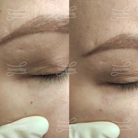 Лазерная деструкция невуса