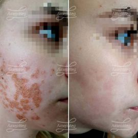 Лечение обострившегося атопического дерматита, осложненного присоединением вторичной инфекции (до и спустя неделю)