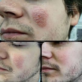 Лечение экзематида на лице, длительность лечения 12 дней