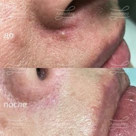 Удаление родинки