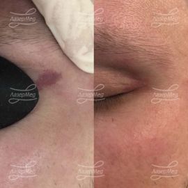 Удаление винного пятна