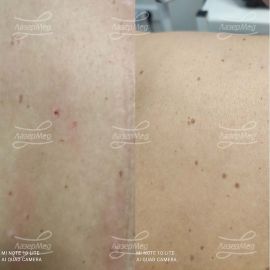 Удаление кератоза