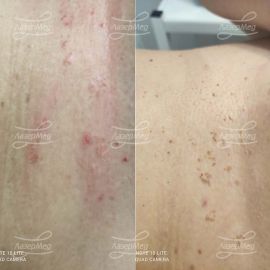 Удаление кератоза