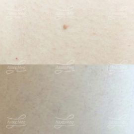 Удаление папилломы и гемангиомы