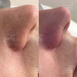 Удаление сосудов