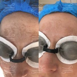 Лечение пигментации