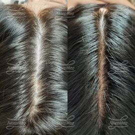 Мезотерапия дермахил