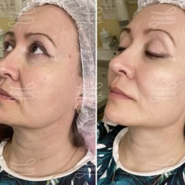 Коррекция линии овала лица