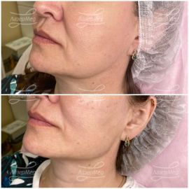 Коррекция линии овала лица