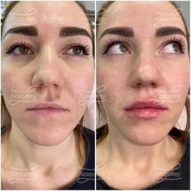 Коррекция губ