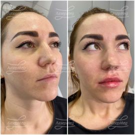 Коррекция губ