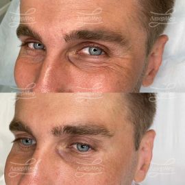 Ботулинотерапия области лба и глаз